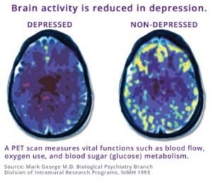 Brain Activity During TMS Therapy